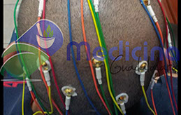 En contraste contra un electroencefalograma normal, cuando hay crisis o epiilepsia el registro eléctrico cambia de forma sutil hasta drástica. 